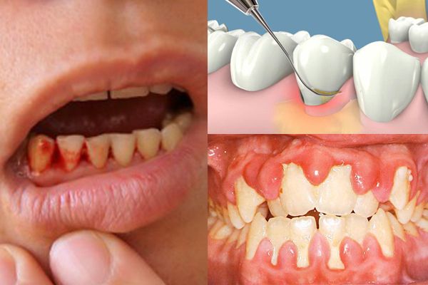 Nhức răng và nướu răng hay bị chảy máu điều trị thế nào?