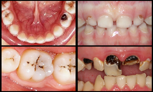 Răng bị sâu do chải răng không đúng cách