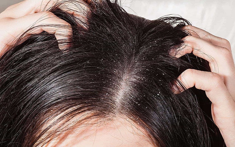 Nguyên nhân gây nấm da đầu là gì và cách chữa trị triệt với dầu gội bồ kết